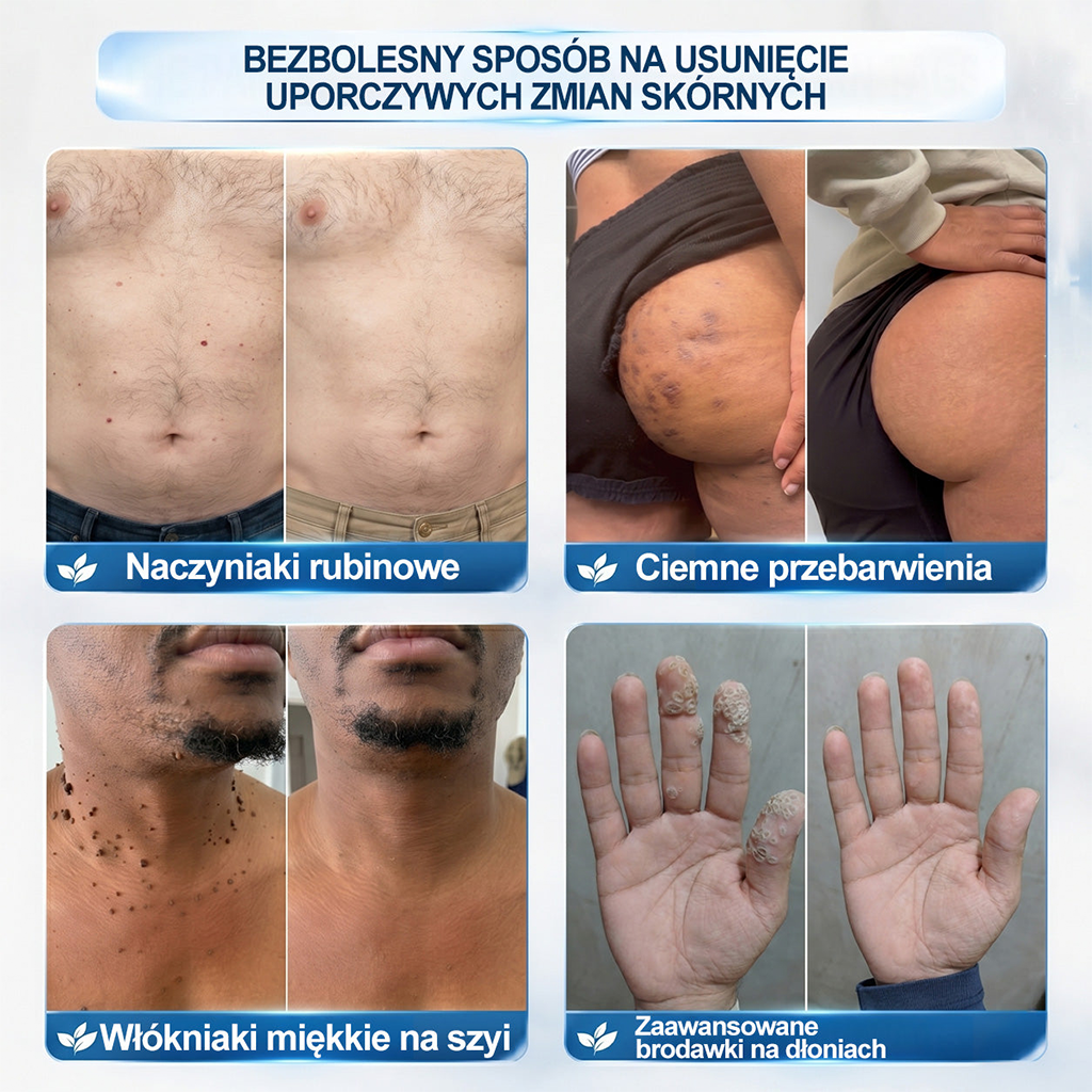 🎉🧨Oficjalny Sklep Markowy |  𝐇𝐞𝐚𝐥𝐫𝐢𝐳𝐞® 7-Dniowy 𝗧𝗮𝗴 & 𝗦𝗽𝗼𝐭 𝐄𝐫𝐚𝐬𝐞𝐫 (Bez bólu, Bez blizn – aplikator z kulką)