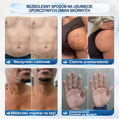 🎉🧨Oficjalny Sklep Markowy |  𝐇𝐞𝐚𝐥𝐫𝐢𝐳𝐞® 7-Dniowy 𝗧𝗮𝗴 & 𝗦𝗽𝗼𝐭 𝐄𝐫𝐚𝐬𝐞𝐫 (Bez bólu, Bez blizn – aplikator z kulką)